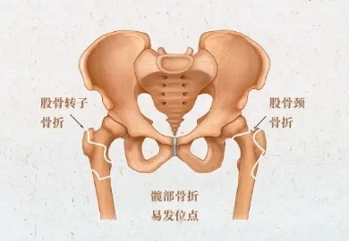 近日,101周岁的陈奶奶翻身下床的时候跌了一跤,右侧髋骨剧痛难忍.
